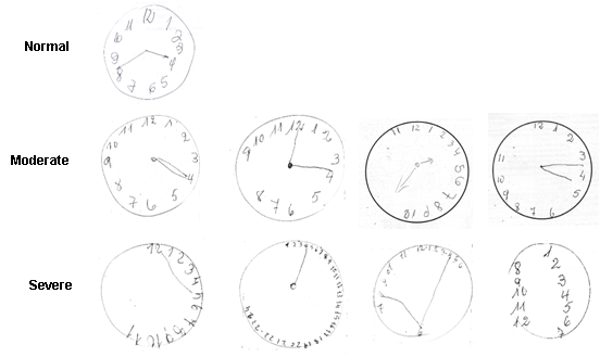Inspirasi 20+ Cognitive Clock Drawing Test